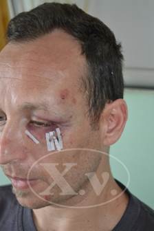 Δολοφονική επίθεση με ρατσιστικά ελατήρια σε γιατρό στα Χανιά